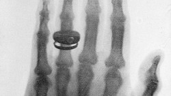 Foto rontgen merupakan prosedur pemeriksaan kesehatan menggunakan sinar-X untuk memperlihatkan gambar bagian tubuh.