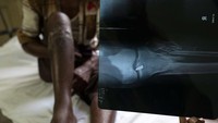 Seorang pengungsi Rohingya di Bangladesh, memperlihatkan x-ray yang menunjukkan sebuah peluru bersarang di lututnya pada 12 September 2017 lalu.