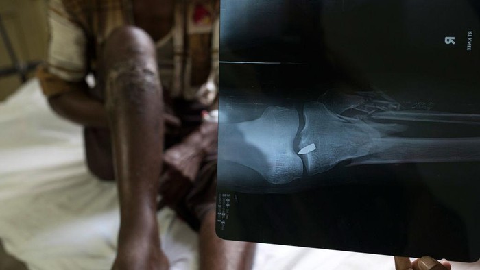 Foto rontgen merupakan prosedur pemeriksaan kesehatan menggunakan sinar-X untuk memperlihatkan gambar bagian tubuh.