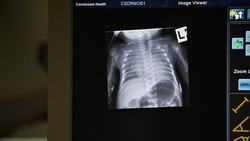 Foto rontgen merupakan prosedur pemeriksaan kesehatan menggunakan sinar-X untuk memperlihatkan gambar bagian tubuh.