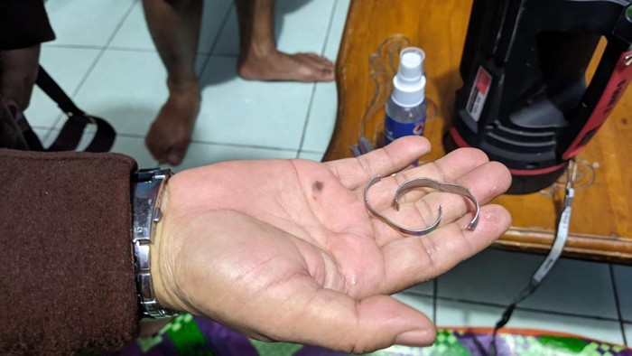 Cincin yang nyangkut di Mr P pria Sukabumi.