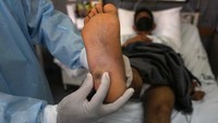 Seorang dokter menunjukkan luka cacar monyet pada kaki pasien di rumah sakit Arzobispo Loayza di Lima, Peru, Selasa (16/8/2022).