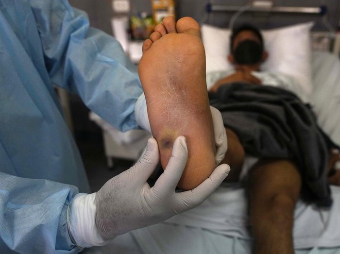 A patient with a monkeypox sore rests at the Arzobispo Loayza hospital in Lima, Peru, Tuesday, Aug. 16, 2022. (AP Photo/Martin Mejia)