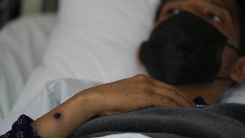 A patient with a monkeypox sore rests at the Arzobispo Loayza hospital in Lima, Peru, Tuesday, Aug. 16, 2022. (AP Photo/Martin Mejia)