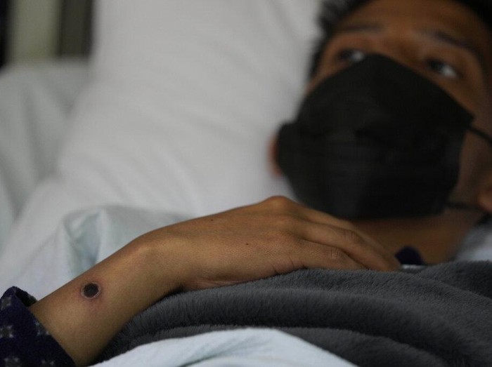 A patient with a monkeypox sore rests at the Arzobispo Loayza hospital in Lima, Peru, Tuesday, Aug. 16, 2022. (AP Photo/Martin Mejia)
