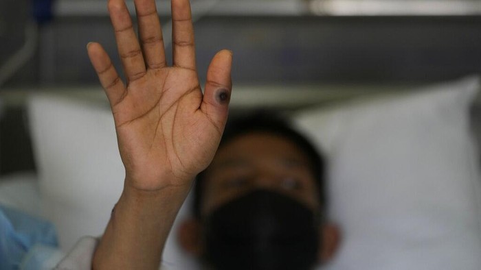 Penampakkan Luka Cacar Monyet Pada Pasien di Peru A patient with a monkeypox sore rests at the Arzobispo Loayza hospital in Lima, Peru, Tuesday, Aug. 16, 2022. (AP Photo/Martin Mejia)