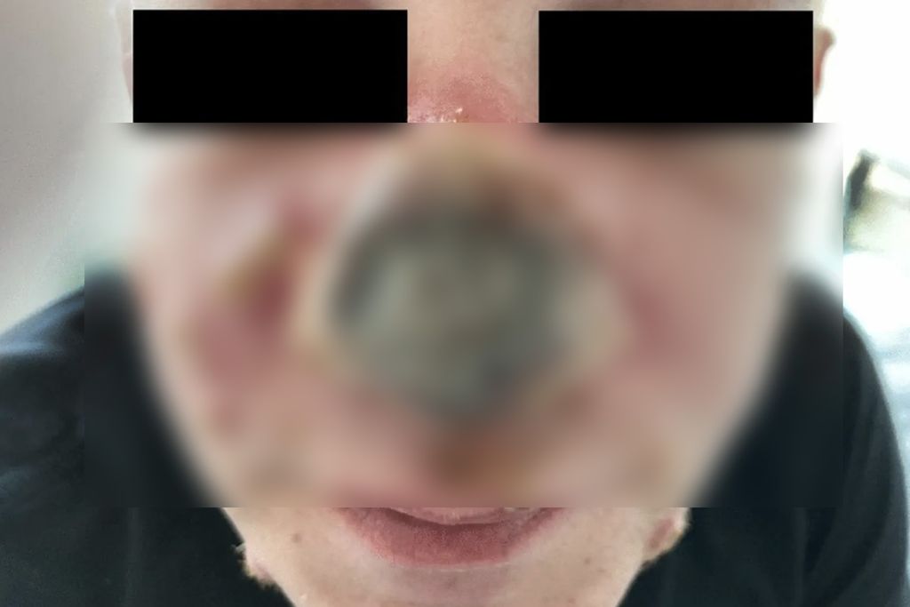 Hidung pria itu mulai membusuk setelah diagnosis cacar monyet (Tangkapan layar via PHOTO BY BOESECKE, C., MONIN, M.B., VAN BREMEN, K., SCHLABE, S., HOFFMAN, C. /Infection)