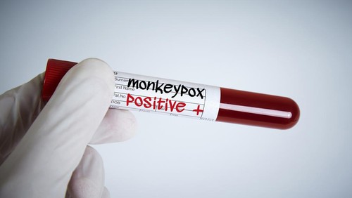 Cacar Monyet Masuk Indonesia dan 5 Hal yang Perlu Diketahui