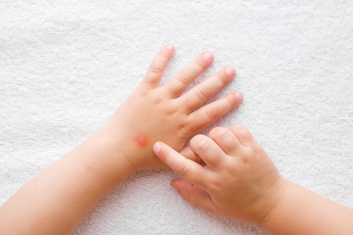 Baby girl finger pointing to itchy hand skin after mosquito bites on white towel background. Point of view shot. Closeup. Top down view.