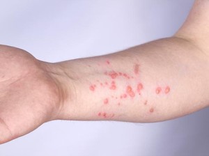 Kondisi Terkini Pasien Italia yang Positif Covid-19, Cacar Monyet dan HIV