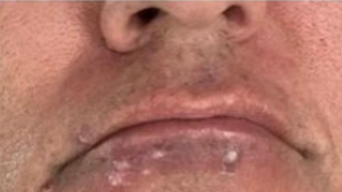 Berdasarkan foto yang diunggah, gejala cacar monyet timbul pada 11 Juli 2022. Pada hari pertama, timbul benjolan-benjolan kecil di mulut bawahnya. Awalnya, ia mengira bahwa benjolan tersebut terjadi karena luka bakar dari pisau cukur.