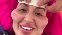Akibatnya, bekas suntikan pada dahinya itu menimbulkan pembengkakan. Yang disuntikan pada dahi saya ini adalah botox, tulis Anastasia dalam video unggahan pribadi di instagramnya. (Foto: Instagram/@justqueen8888)