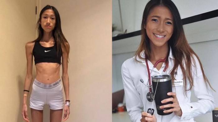 Dokter anoreksia Penampilan seorang dokter mengidap anoreksia