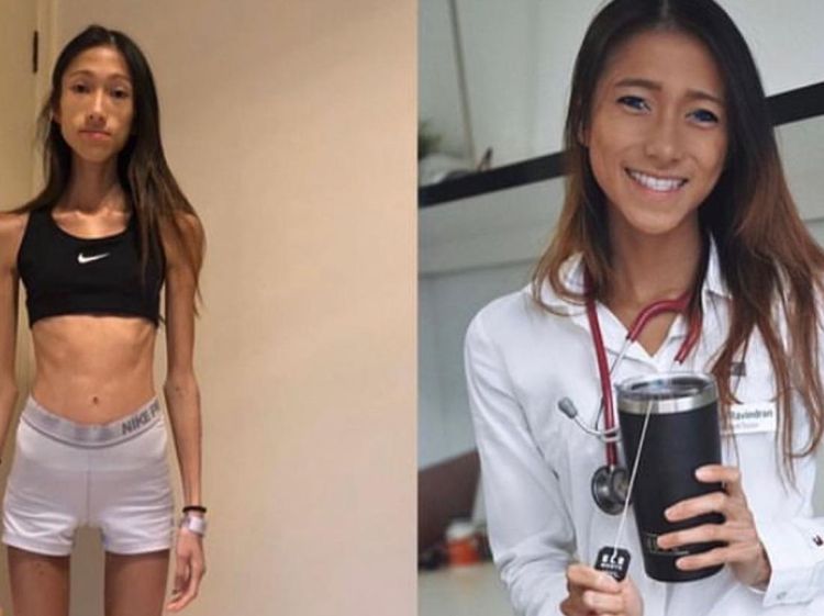 Penampilan Dokter Obsesi Kurus Berujung Anoreksia Parah, BB Cuma 30 Kg