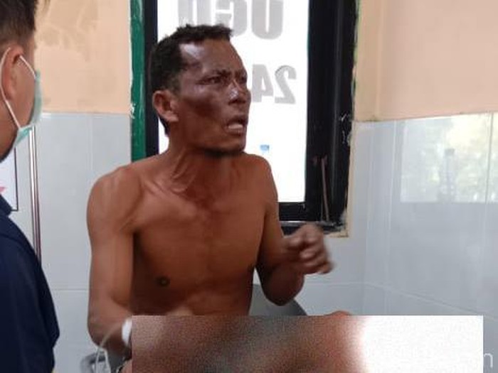 ABK KLM Aven Selon 03 yang mengalami luka bakar dan harus menjalani perawatan di Puskesmas
