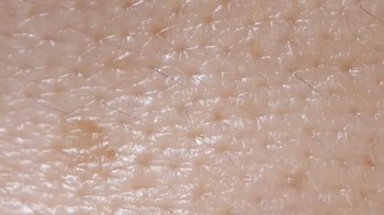 Meskipun Demodex tidak membahayakan nyawa, jumlahnya yang besar dapat menyebabkan infeksi kulit, seperti jerawat hingga rosacea. Foto: dok. Instagram/ wowfact.id