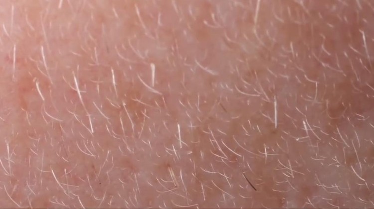 Beberapa mikroorganisme hidup pada kulit dan wajah manusia. Salah satunya adalah tungau wajah atau Demodex folliculorum.