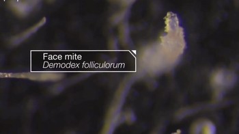 Di luar permukaan kulit. Pada umumnya, tungau ini lebih banyak ditemukan di area wajah. Foto: dok. Instagram/ wowfact.id