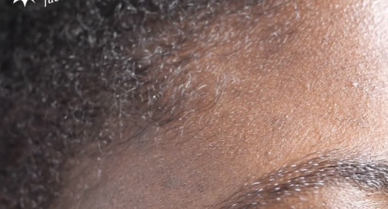 Beberapa mikroorganisme hidup pada kulit dan wajah manusia. Salah satunya adalah tungau wajah atau Demodex folliculorum.