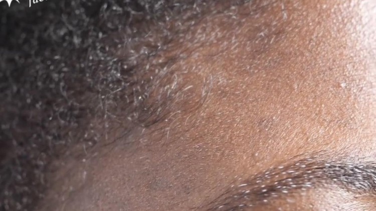 Beberapa mikroorganisme hidup pada kulit dan wajah manusia. Salah satunya adalah tungau wajah atau Demodex folliculorum.