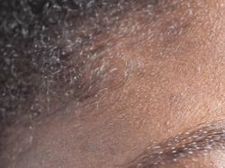 Wajah Kita Ternyata Tempat Bersarang Kutu!