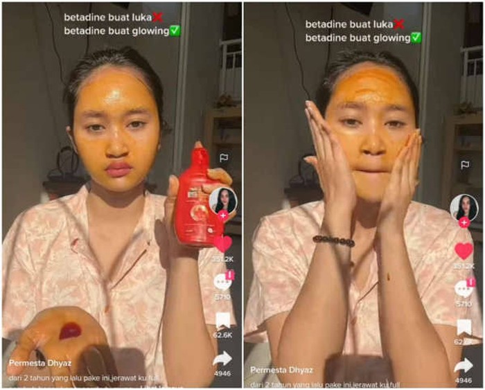 Atasi jerawat pakai Betadine jadi viral