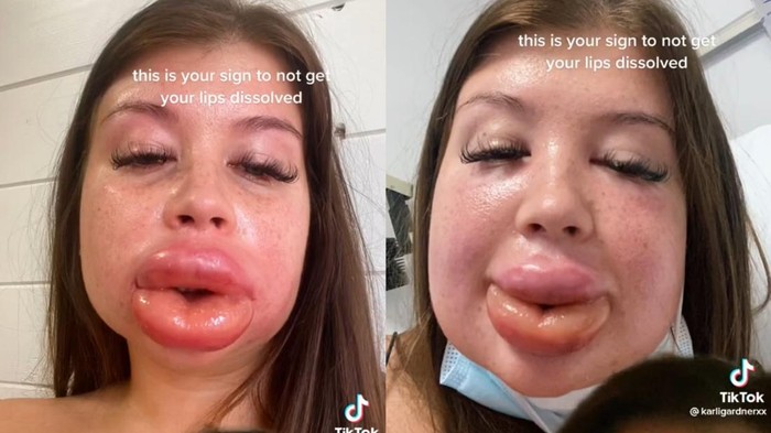 Viral bibir hampir meletus