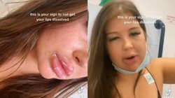 Viral bibir seorang wanita mengalami pembengkakan dan hampir menutupi seluruh wajahnya. Ia mengalami kondisi mengerikan ini usai filler bibir.