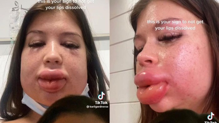 Viral bibir hampir meletus