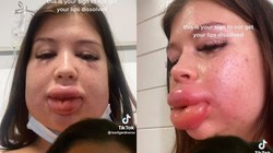 Viral bibir seorang wanita mengalami pembengkakan dan hampir menutupi seluruh wajahnya. Ia mengalami kondisi mengerikan ini usai filler bibir.