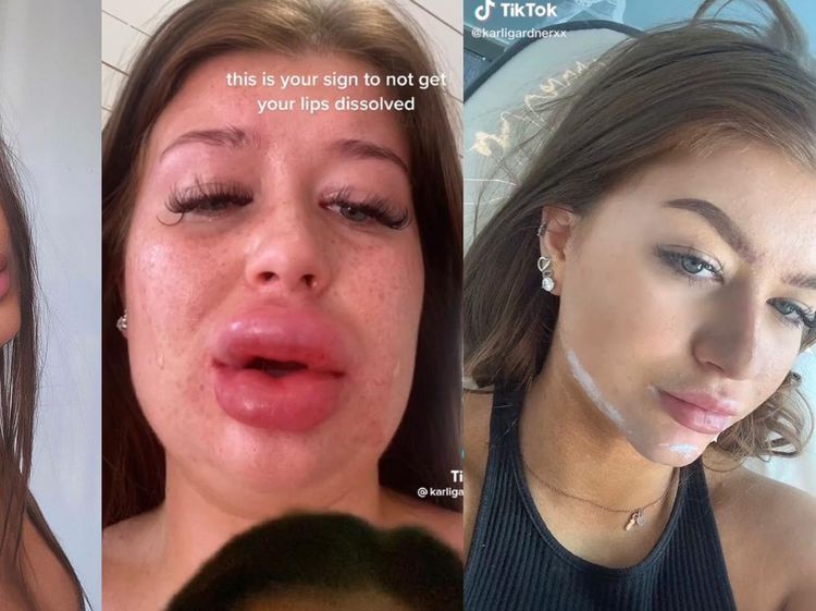 Potret Bibir Wanita Hampir Meletus Gara-gara Suntik Filler