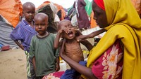 Seorang ibu menenangkan anaknya yang mengalami gizi buruk, kurus dan tak terawat. Kekeringan di wilayah Somalia membuat jutaan orang kelaparan.  