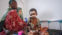 Anak kecil dirawat dengan peralatan medis yang tidak memadai. Dilaporkan setidaknya 448 orang meninggal di pusat perawatan malnutrisi rawat jalan dan rawat inap di seluruh Somalia tahun ini.  