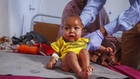 Seorang bayi diperiksa tim medis dengan diagnosa gizi buruk. Negara ini terpukul karena, salah satunya, akibat 90 persen makanan pokok berupa gandum diimpor dari Ukraina.   