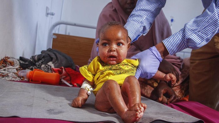 Derita Anak-anak Somalia Dihantui Gizi Buruk Nurto Mohamud Ali, 45, who fled the drought-stricken Lower Shabelle region, sits next to her malnourished son Mohamud Hussein, 2, at a camp for the displaced on the outskirts of Mogadishu, Somalia Saturday, Sept. 3, 2022. Millions of people in the Horn of Africa region are going hungry because of drought, and thousands have died, with Somalia especially hard hit because it sourced at least 90 percent of its grain from Ukraine and Russia before Russia invaded Ukraine. (AP Photo/Farah Abdi Warsameh)