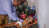 Petugas medis memeriksa kesehatan anak kecil yang menjadi korban gizi buruk.  