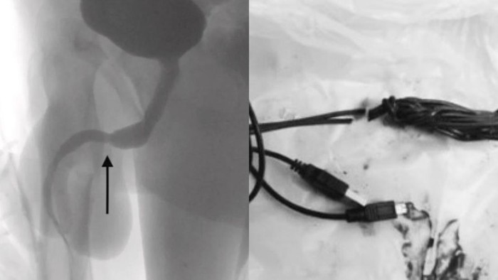 Kabel USB menyangkut di penis remaja berusia 15 tahun Kabel USB menyangkut di penis remaja berusia 15 tahun