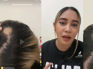 Viral Wanita Jakarta Curhat Mendadak Pitak, Ternyata Kena Penyakit Ini