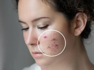 Tak Cuma Skincare, 5 Makanan Ini Efektif Bantu Atasi Jerawat
