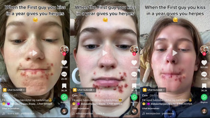 Herpes Herpes viral