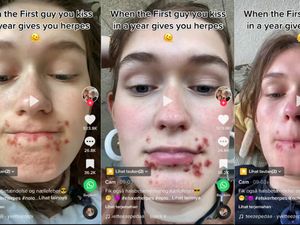 Viral Wanita Kena Herpes Gegara Ciuman, Memang Apa Saja Penularannya?