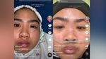 Foto Before-After Wanita Bekasi Kena COVID dan Sindrom Langka Sekaligus