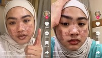 Tidak hanya bibir yang menghitam, wajah dan nyaris sekujur tubuhnya dipenuhi ruam. Ruam muncul usai dirinya mengonsumsi dua obat tertentu pasca teridentifikasi positif COVID-19.  (Foto: Tangkapan layar: SS Viral (atas izin yang bersangkutan)