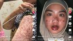 Foto Before-After Wanita Bekasi Kena COVID dan Sindrom Langka Sekaligus