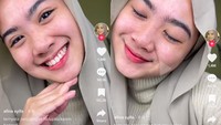 Kini, penampilan kulit Afina sudah kembali seperti semula. Bahkan, bekas-bekas lepuhan ruam di kulit wajah sudah hilang. (Foto: Tangkapan layar: SS Viral (atas izin yang bersangkutan)