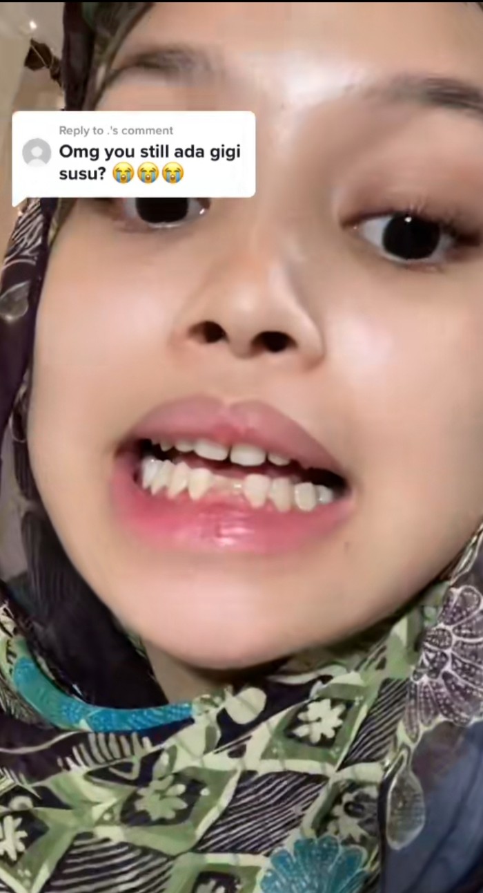 Perempuan 18 Tahun Masih Punya 2 Gigi Susu, Begini Penampakannya