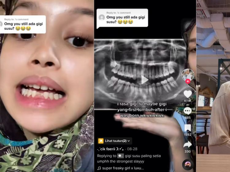 Perempuan 18 Tahun Masih Punya 2 Gigi Susu, Begini Penampakannya