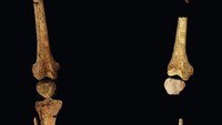 Dr Melandri Vlok, yang memeriksa kerangka tersebut mengatakan kaki kiri kerangka sangat jelas diamputasi. Bahkan, hasil analisis para arkeolog menunjukkan bahwa individu yang diamputasi tersebut dirawat oleh komunitasnya bertahun-tahun setelah operasi dilakukan.  