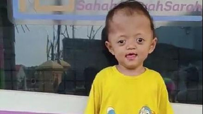 Muhammad Ar Rasyid menderita Sindrom Apart Sindaktili yang diketahui masih langka di Indonesia. Yuk, bantu Rasyid dengan donasi di berbuatbaik.id.