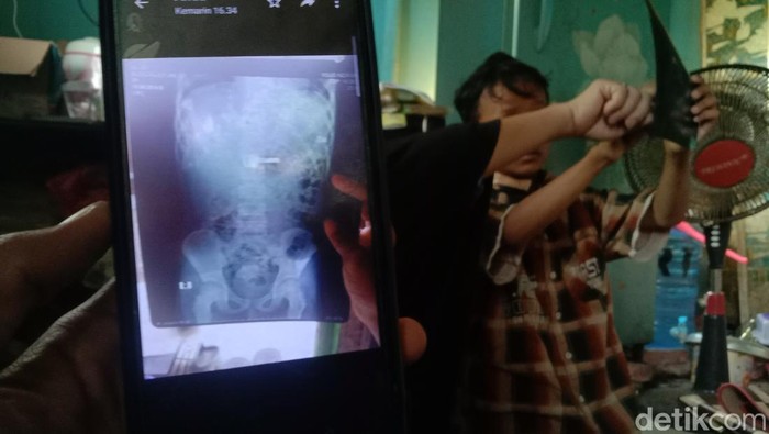Zul (9) dan penampakan kunci yang tak sengaja ia telan di Indramayu